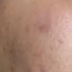 Po zabiegu 1