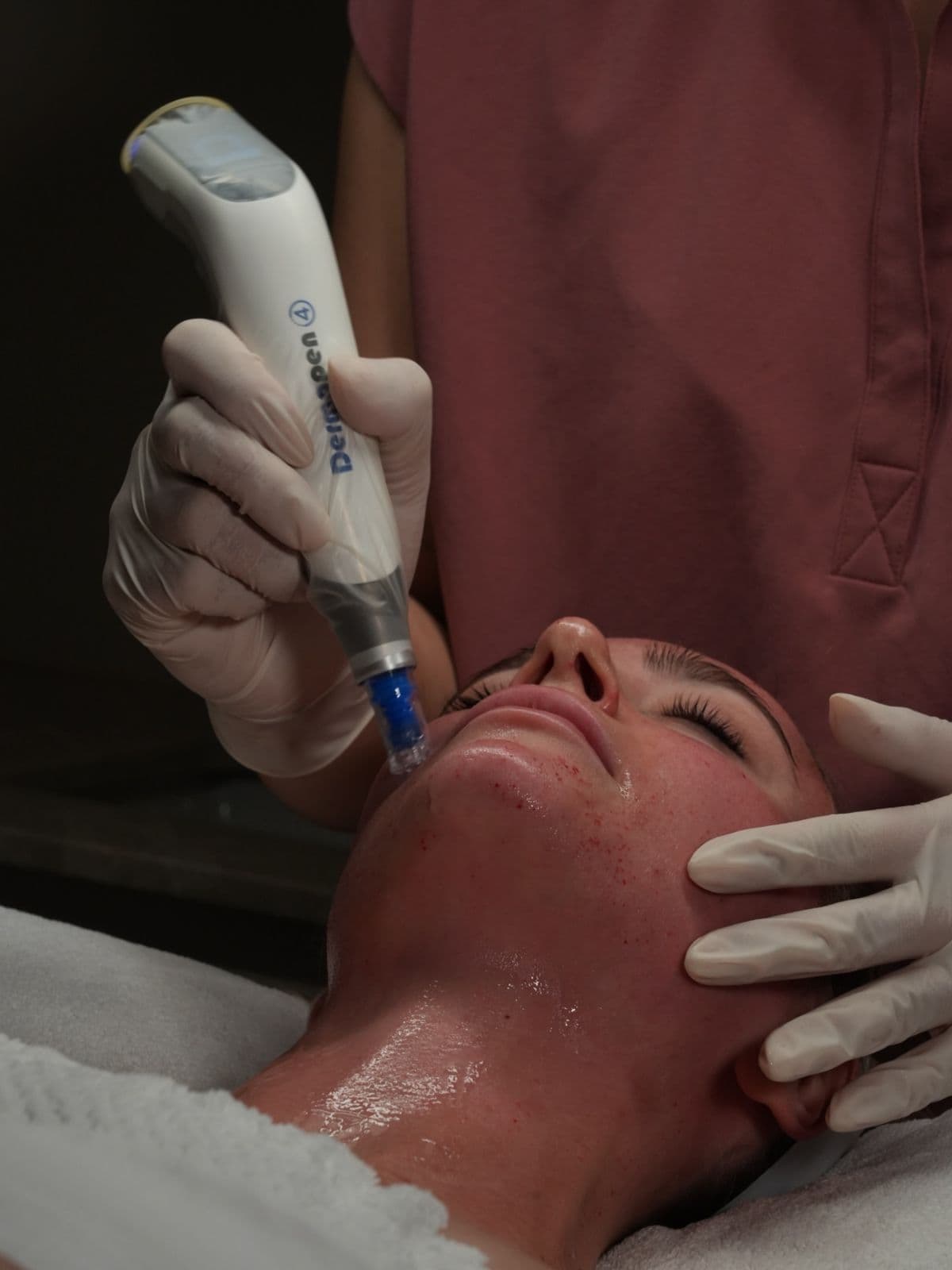 Dermapen 4.0